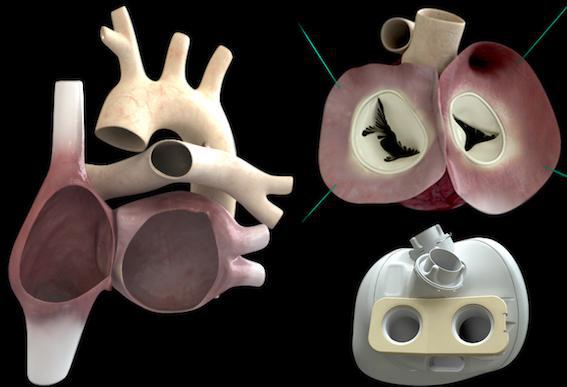 Coeur Carmat : 1ères données cliniques sur les implantations et les décès