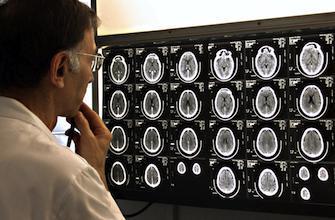 Les lésions cérébrales triplent le risque de décès prématuré