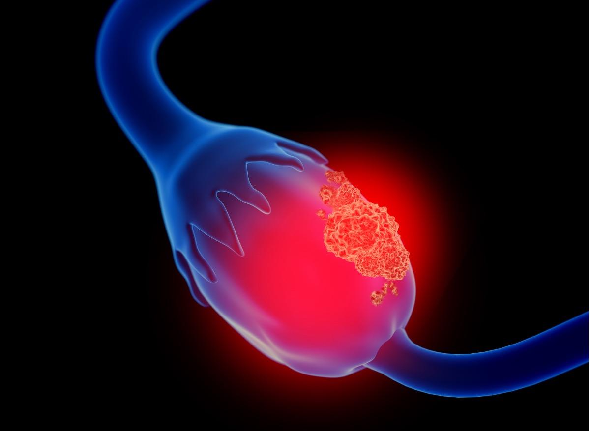Cancer de l’ovaire : neutraliser une protéine pour bloquer le développement des métastases