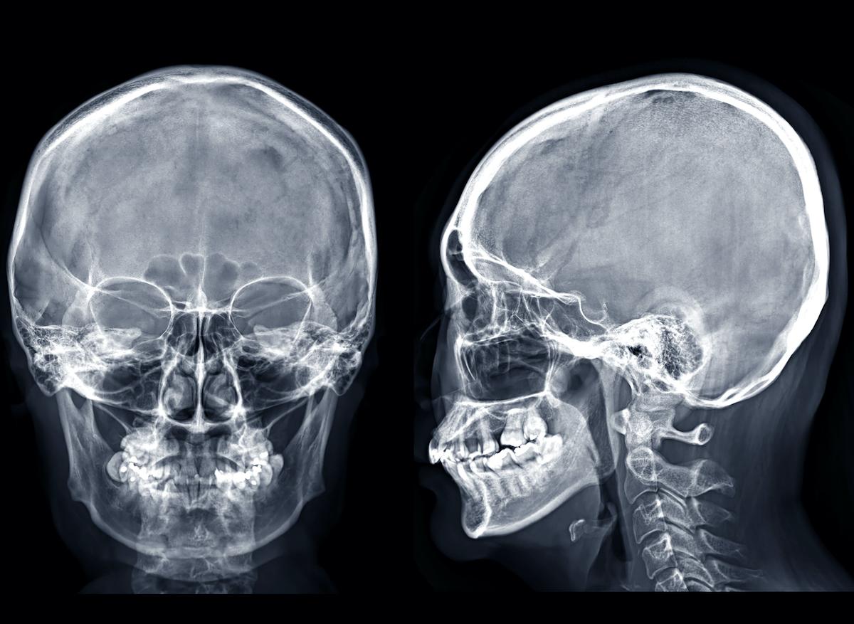 Un nouvel organe découvert dans le crâne humain