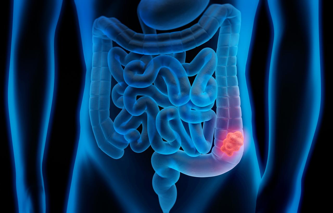 Cancer du côlon : des bactéries intestinales pourraient être un indicateur de risque