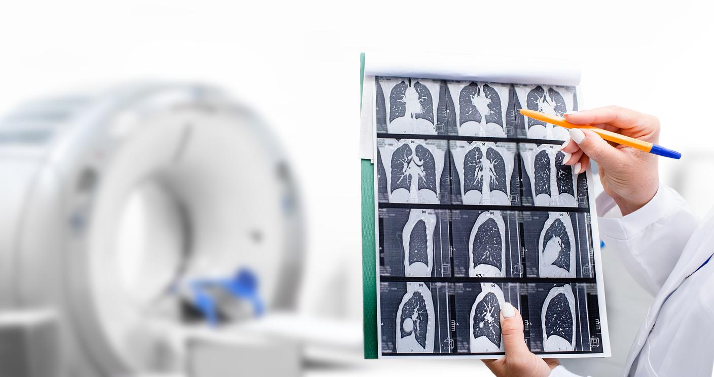 Cancer du poumon : pourquoi il faut aller plus loin dans le dépistage