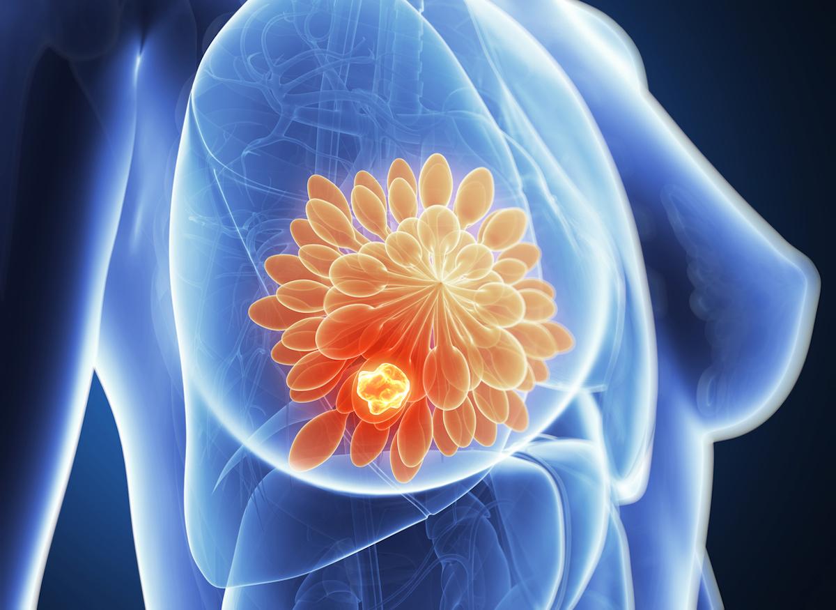 Cancer du sein incurable : un nouveau « médicament intelligent » donne de l'espoir