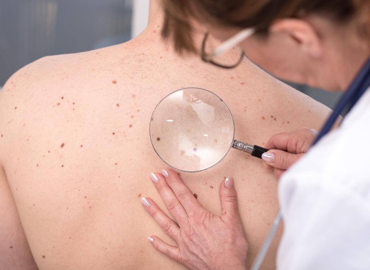 Cancer de la peau : comment reconnaître un grain de beauté à risque ?