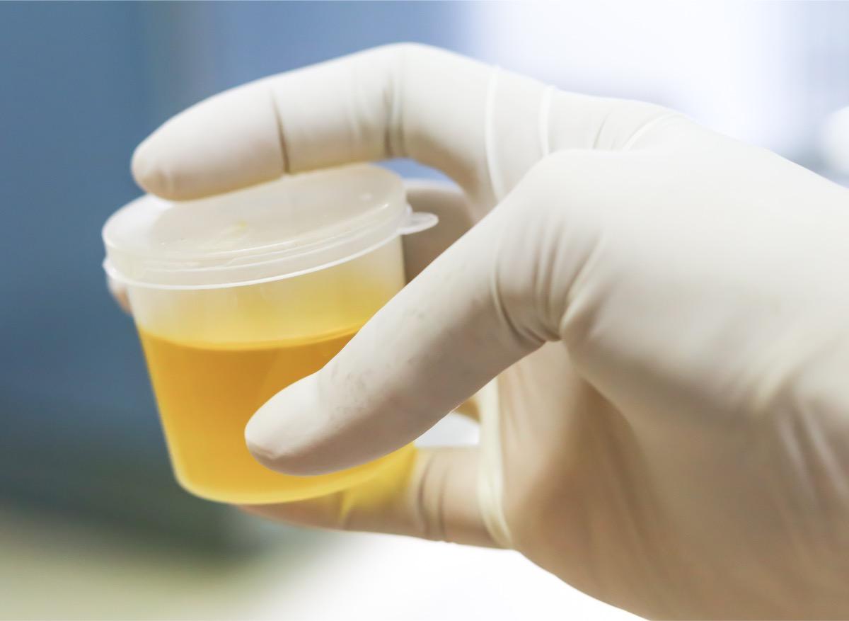 Cancer de la prostate : un test urinaire pour détecter la maladie 