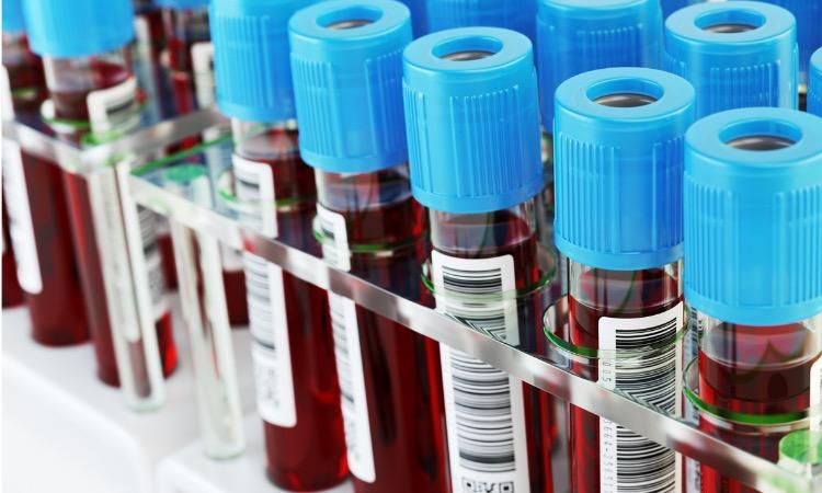 Biopsie liquide : détecter les cancers grâce à une prise de sang
