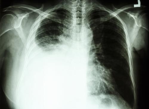 Cancer du poumon : le dépistage inutile chez les fumeurs