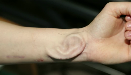 Une greffe d'oreille cultivée sur l'avant-bras d'une patiente