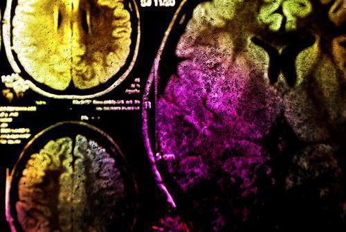 Anévrisme cérébral : des chercheurs découvrent un gène responsable