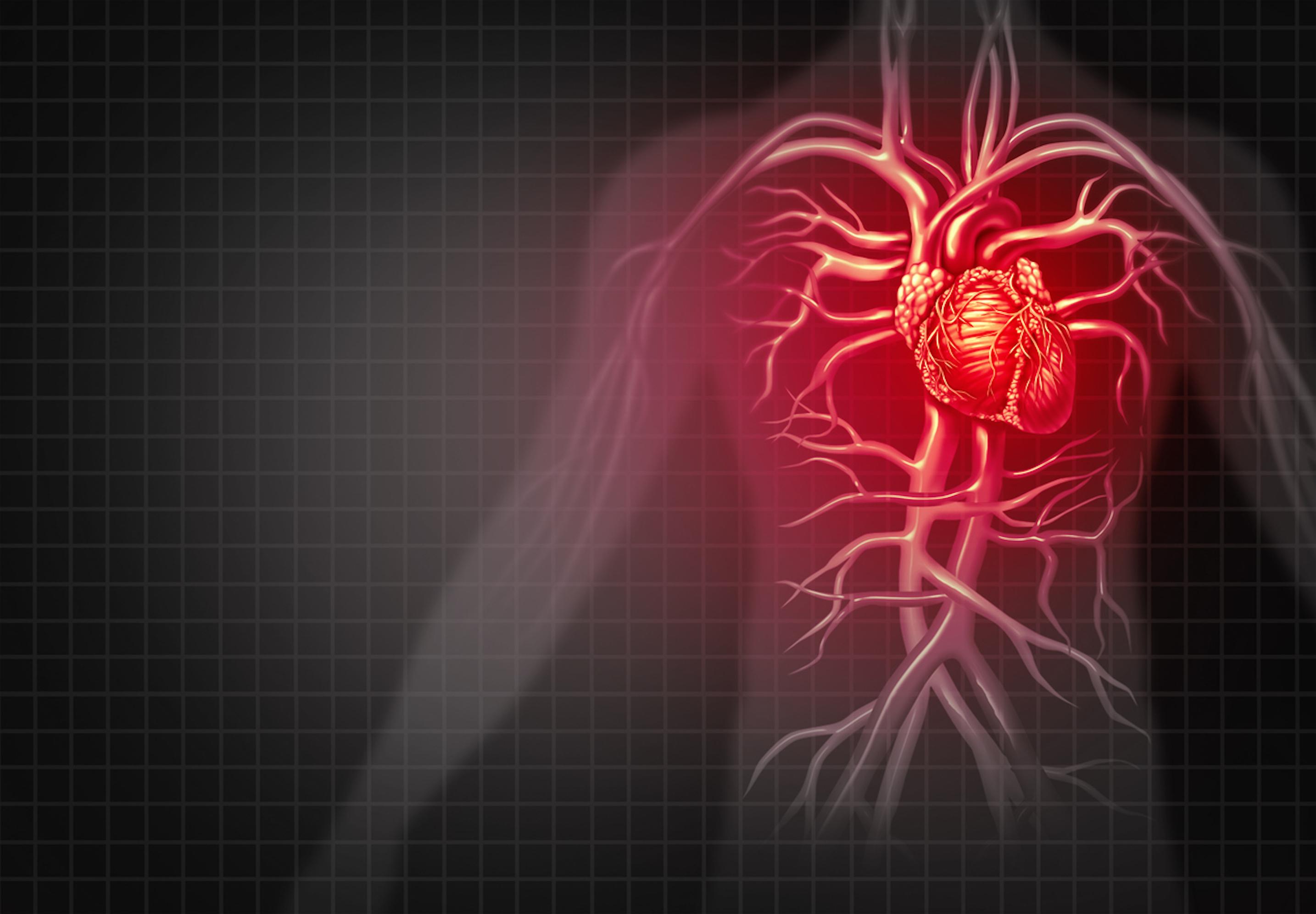 Les maladies inflammatoires des intestins augmentent le risque de crise cardiaque