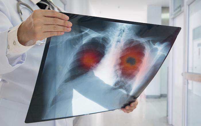 Cancer du poumon : les femmes sont désormais plus touchées que les hommes