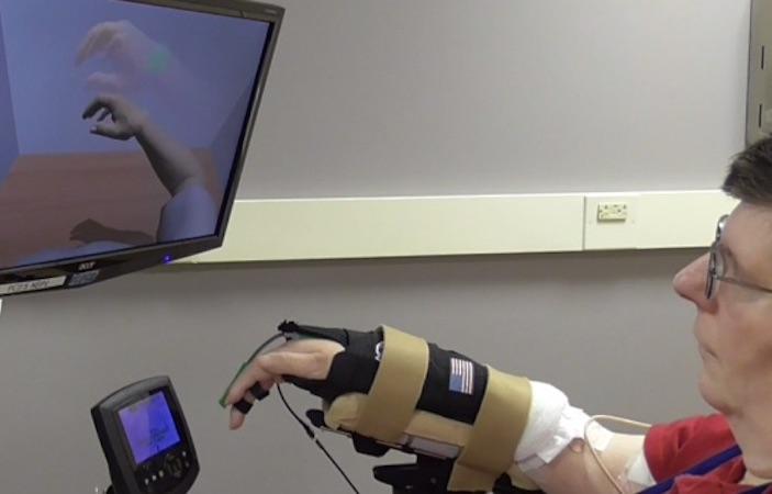 Implants cérébraux : un tétraplégique retrouve l’usage de son bras