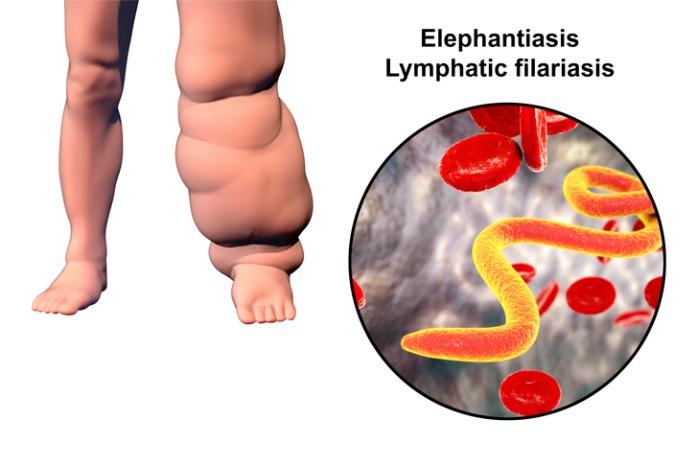 Dans la filariose lymphatique (éléphantiasis), un traitement triple marche dans 100% des cas 
