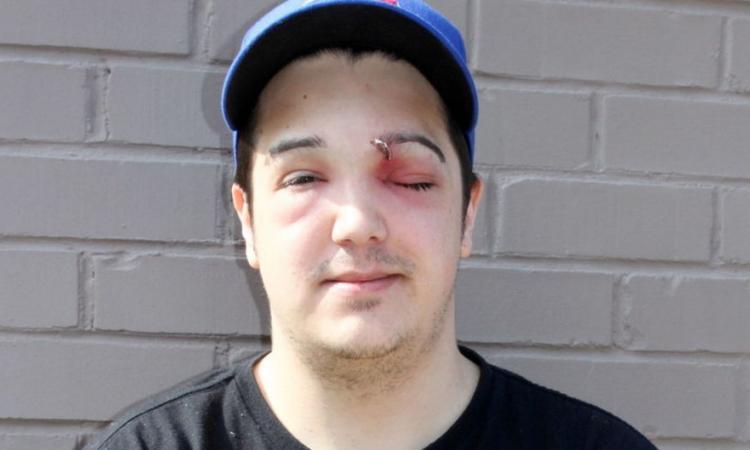 Un Canadien a failli perdre la vue en crevant un bouton 