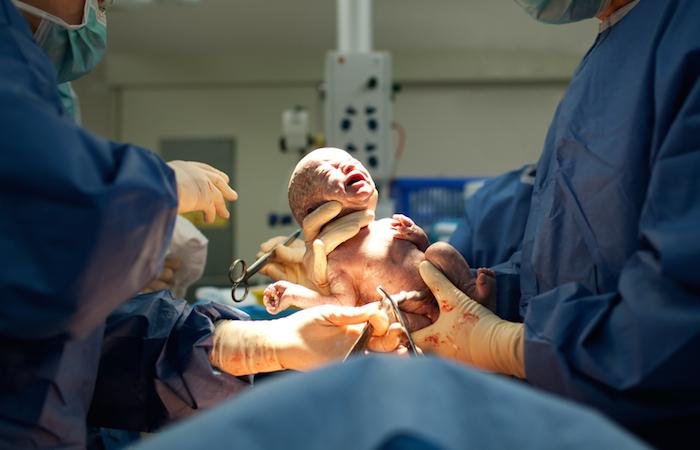 Jumeaux : la césarienne plus risquée que l’accouchement naturel
