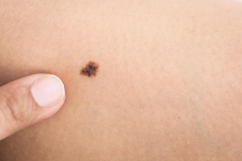 Cancer de la peau : 300 dermatologues offrent un dépistage 