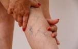 Les pieds froids et les jambes lourdes, un signe de varices ? 