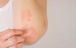 Comment le psoriasis peut devenir une maladie articulaire