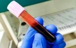SEP : un nouveau test sanguin pour mesurer la réponse immunitaire au virus d'Epstein Barr