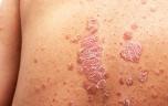 Angine bactérienne et psoriasis : y a-t-il un lien ?