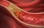 Cholestérol : ce traitement qui permettrait d’éviter les statines