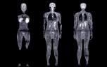 Graisse, cellules... Comment l’obésité endommage tout notre organisme