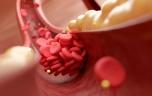 Cholestérol : une nouvelle pilule pour le traiter 
