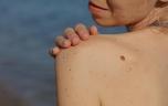 Grains de beauté : comment vérifier soi-même qu’ils ne sont pas cancéreux