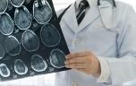 Pourquoi certains AVC sont-ils plus graves que d'autres ?