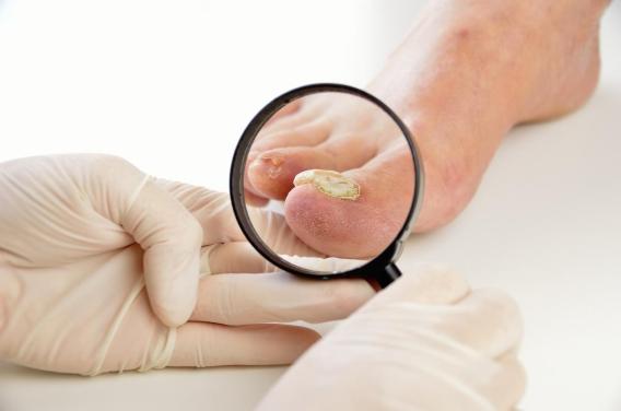 Onychomycose : 4 facteurs augmentant vos risques d'infection fongique des ongles