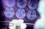 Maladie d'Alzheimer : où en sommes-nous dans les traitements ? 