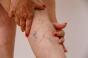 Les pieds froids et les jambes lourdes, un signe de varices ? 