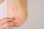 Biothérapies dans le psoriasis : peut-on réduire la posologie sans risque ?