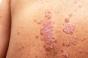 Angine bactérienne et psoriasis : y a-t-il un lien ?