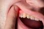 Fibrillation auriculaire : la parodontite peut être un facteur de risque