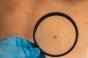 Cancer de la peau : comment le contrôle de l'inflammation liée à un coup de soleil peut le prévenir