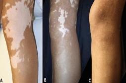 Vitiligo : l'autogreffe de peau est efficace à long terme