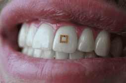 Des capteurs sur les dents pour mieux surveiller son alimentation