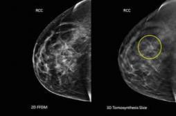 Cancer du sein : la chirurgie conservatrice expose à une récidive dans 1 cas sur 4