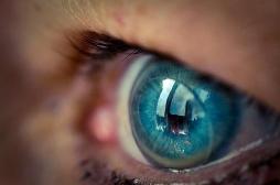 Cataracte : 27 lentilles retrouvées dans l'oeil d'une Anglaise
