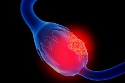 Cancer de l’ovaire : neutraliser une protéine pour bloquer le développement des métastases