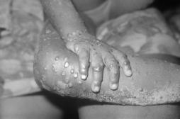 Deux cas de variole du singe rapportés au Royaume-Uni et aucun traitement en vue
