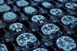 Alzheimer : des fuites répérées dans le cerveau