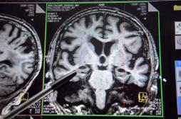 Alzheimer : des dépôts anormaux de graisse dans le cerveau 