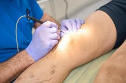 Une jambe enflée : ce n’était pas un symptôme de puberté mais un mélanome !