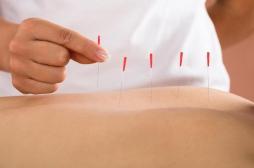 Acupuncture : comment elle peut réduire la douleur