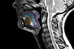Une IRM de la langue pourrait aider à détecter la maladie de Charcot 