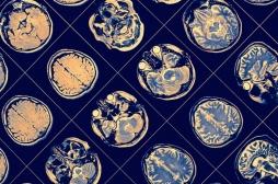 Maladie d’Alzheimer : faut-il des traitements en fonction du sexe ? 