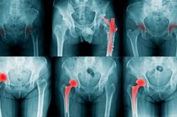 Ostéoporose: les facteurs de risque de fracture mieux identifiés