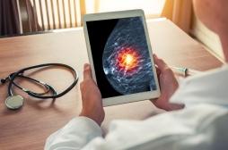 Cancer du sein : inquiétude face à la baisse des dépistages en 2020